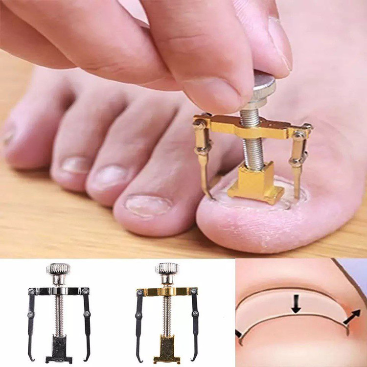 گیره ارتودنسی ناخن ارتونیل